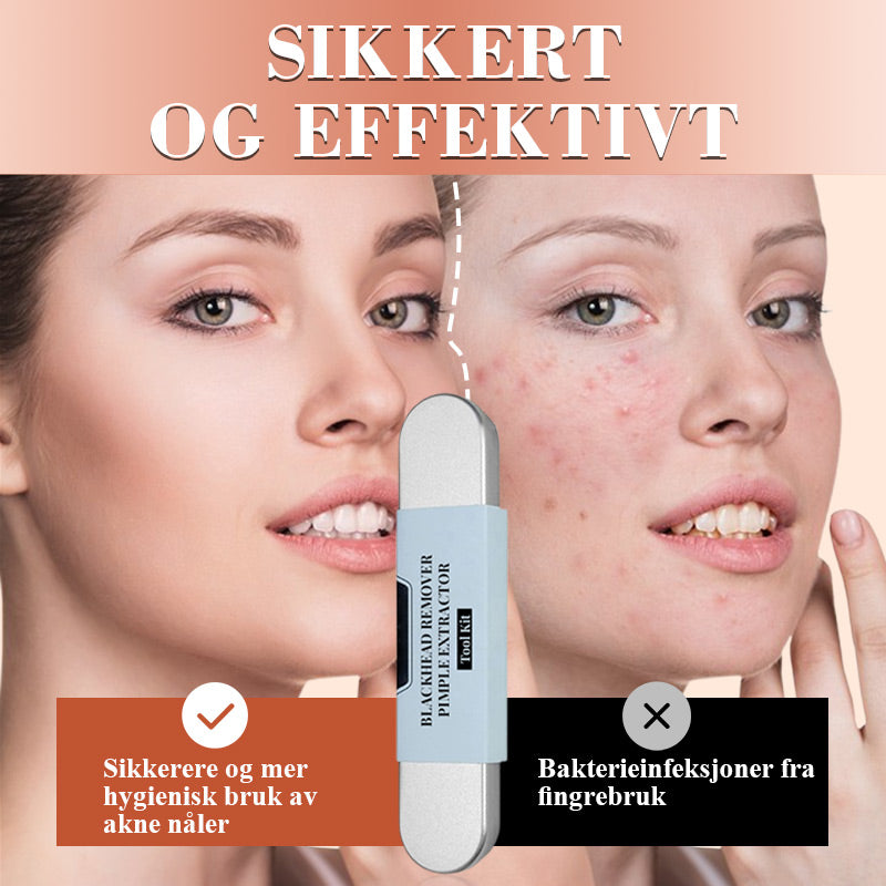 💓💥Hudorm fjerner kvise avtrekkerverktøysett